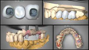 tgvtht همانطوریکه در تمام جنبه های زندگی امروزی دیجیتالی شده است درمان ایمپلنت دیجیتال نیز جای خود را در بین درمان های دندانپزشکی باز کرده است .